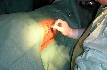discólisis con ozono intradiscal