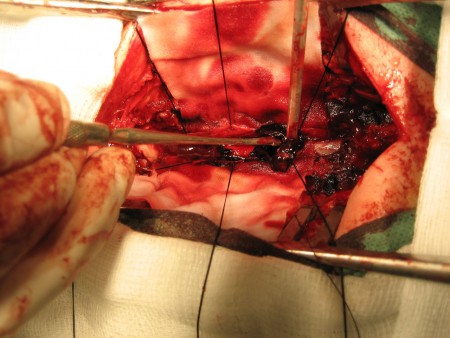 hematoma subdural torácico